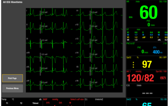 Computerised ECG 3
